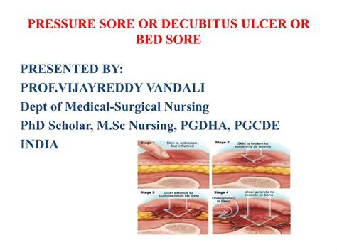 The Importance of Decubitus Ulcer Therapy