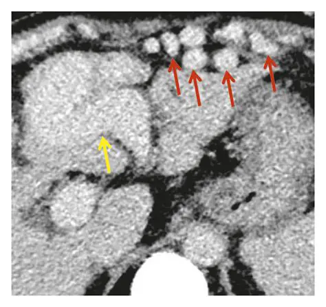 The Relationship Between a Recanalized Umbilical Vein and Liver Conditions